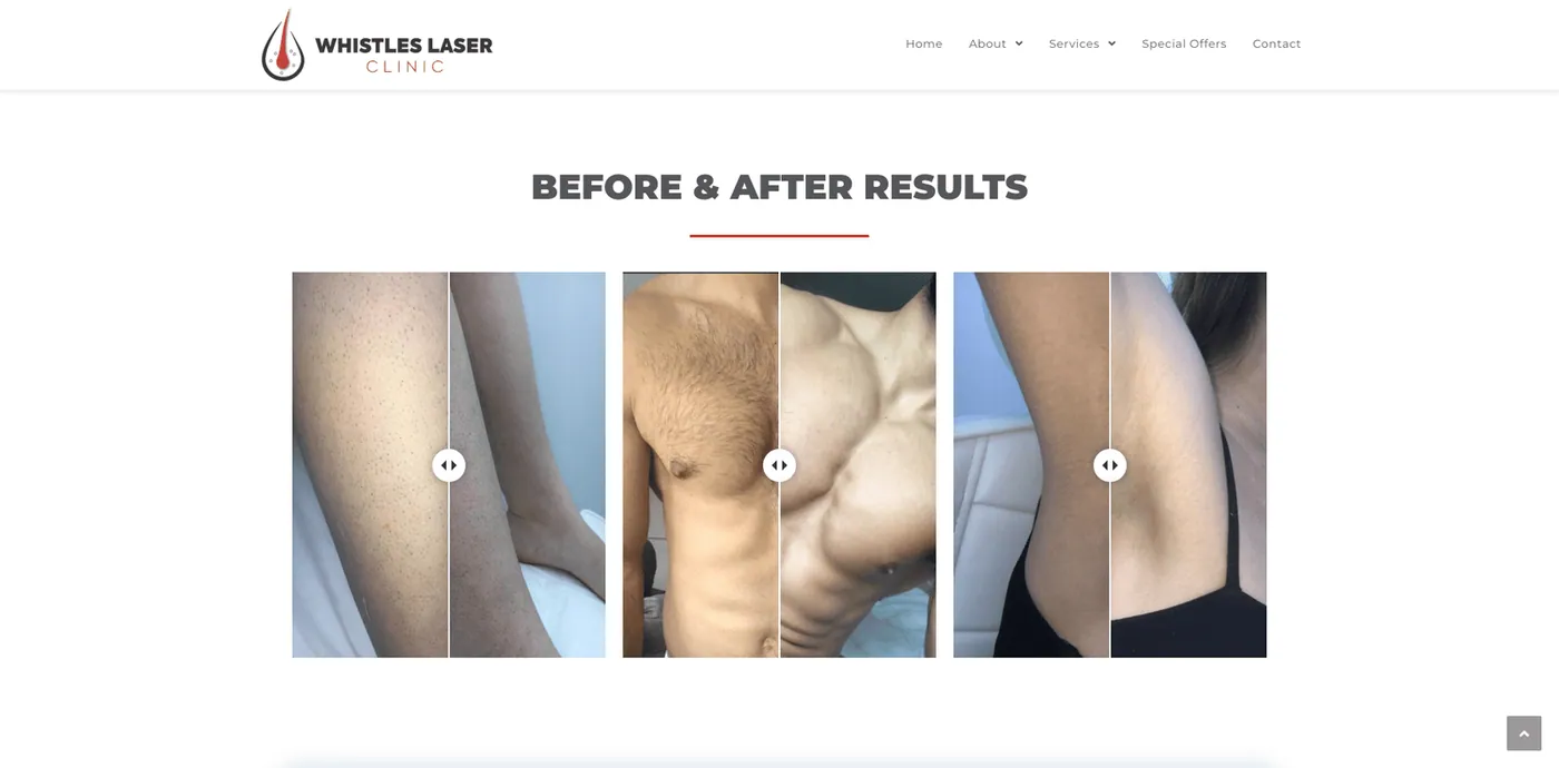 Whistles Laser Clinic — Before & Afters